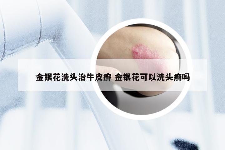 金银花洗头治牛皮癣 金银花可以洗头癣吗