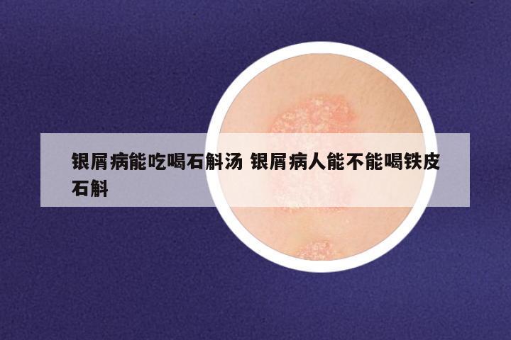 银屑病能吃喝石斛汤 银屑病人能不能喝铁皮石斛