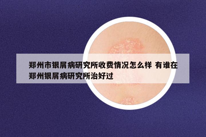 郑州市银屑病研究所收费情况怎么样 有谁在郑州银屑病研究所治好过