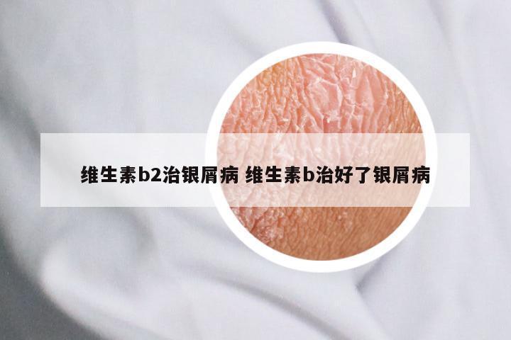 维生素b2治银屑病 维生素b治好了银屑病