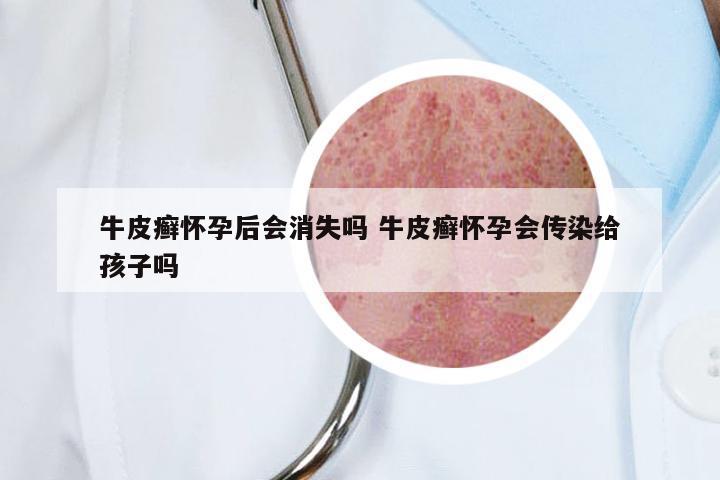 牛皮癣怀孕后会消失吗 牛皮癣怀孕会传染给孩子吗
