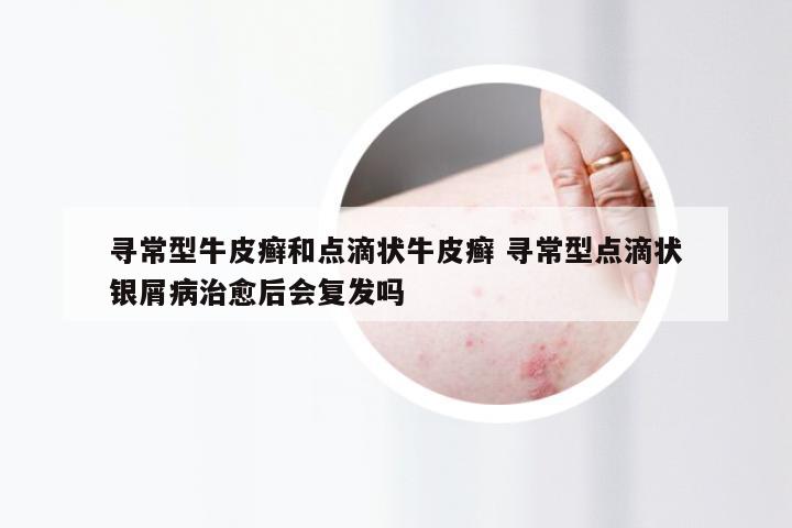 寻常型牛皮癣和点滴状牛皮癣 寻常型点滴状银屑病治愈后会复发吗