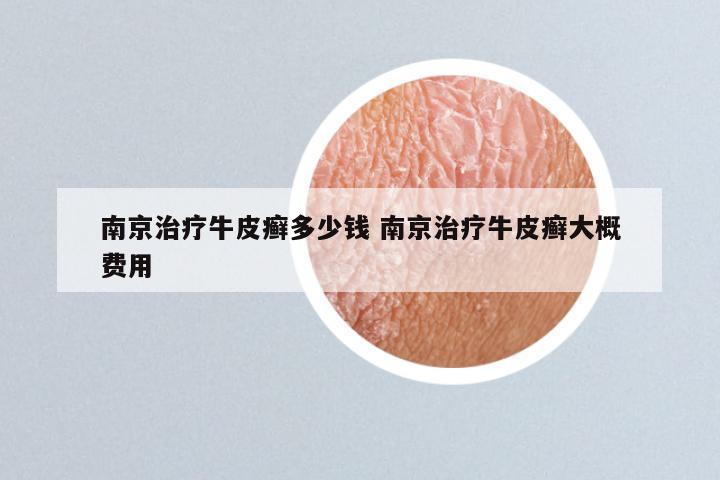 南京治疗牛皮癣多少钱 南京治疗牛皮癣大概费用