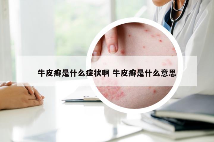 牛皮癣是什么症状啊 牛皮癣是什么意思