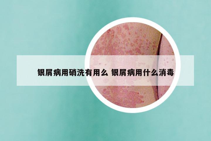 银屑病用硝洗有用么 银屑病用什么消毒