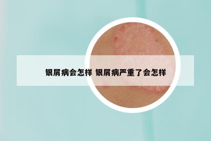 银屑病会怎样 银屑病严重了会怎样