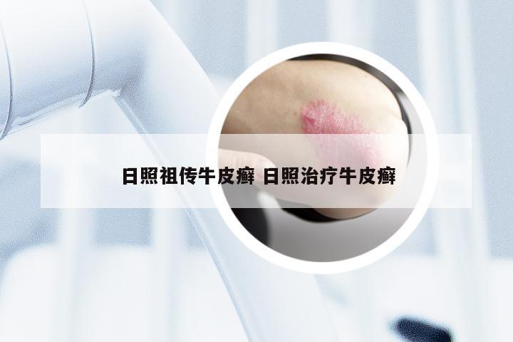 日照祖传牛皮癣 日照治疗牛皮癣