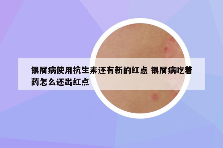 银屑病使用抗生素还有新的红点 银屑病吃着药怎么还出红点