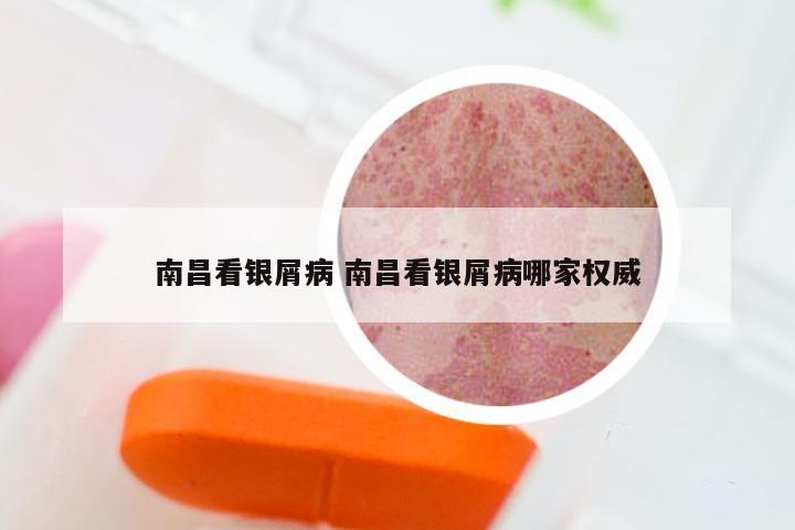 南昌看银屑病 南昌看银屑病哪家权威