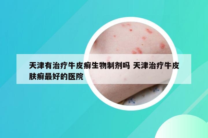 天津有治疗牛皮癣生物制剂吗 天津治疗牛皮肤癣最好的医院