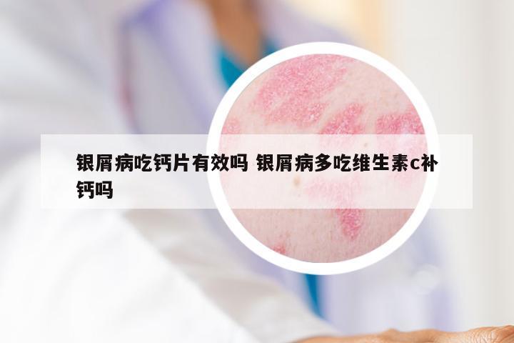 银屑病吃钙片有效吗 银屑病多吃维生素c补钙吗