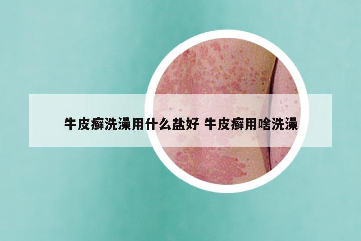 牛皮癣洗澡用什么盐好 牛皮癣用啥洗澡
