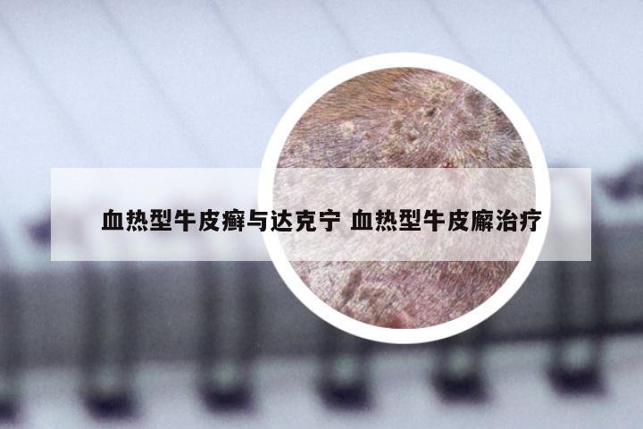 血热型牛皮癣与达克宁 血热型牛皮廨治疗