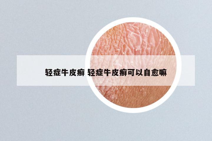 轻症牛皮癣 轻症牛皮癣可以自愈嘛
