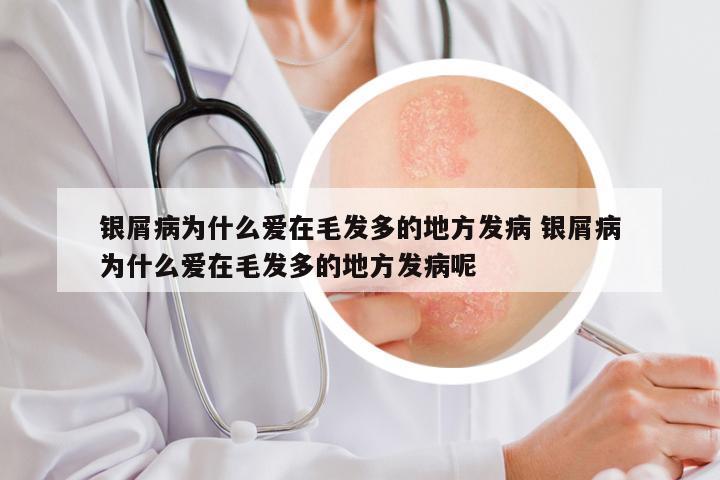 银屑病为什么爱在毛发多的地方发病 银屑病为什么爱在毛发多的地方发病呢