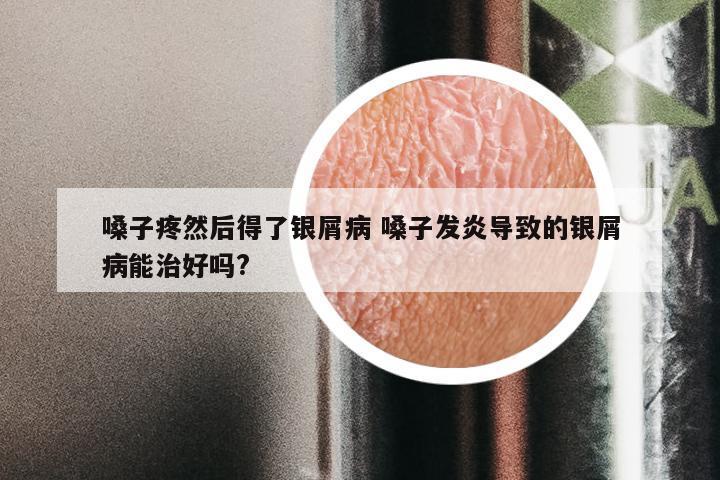 嗓子疼然后得了银屑病 嗓子发炎导致的银屑病能治好吗?