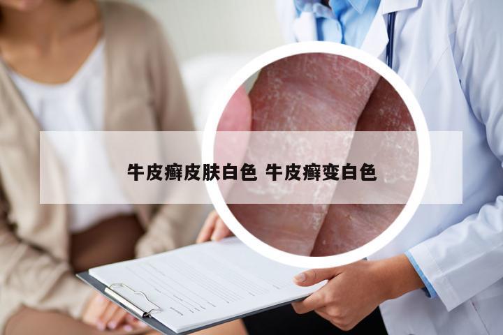 牛皮癣皮肤白色 牛皮癣变白色