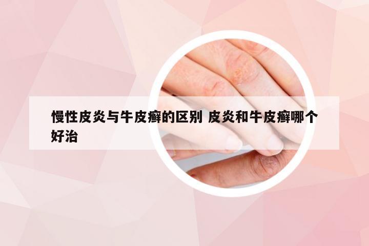 慢性皮炎与牛皮癣的区别 皮炎和牛皮癣哪个好治
