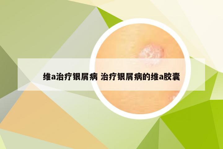维a治疗银屑病 治疗银屑病的维a胶囊