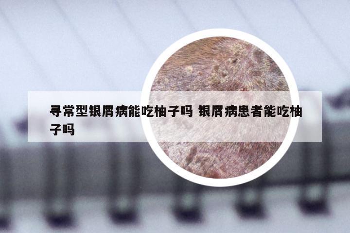 寻常型银屑病能吃柚子吗 银屑病患者能吃柚子吗