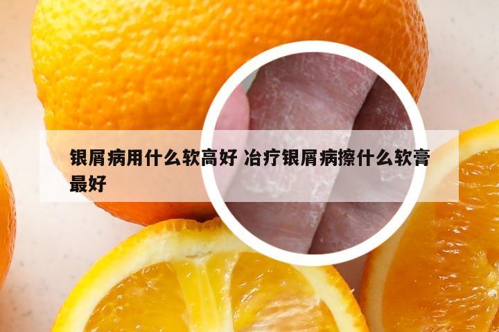 银屑病用什么软高好 冶疗银屑病擦什么软膏最好
