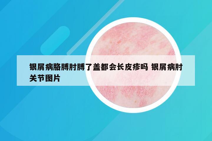 银屑病胳膊肘膊了盖都会长皮疹吗 银屑病肘关节图片