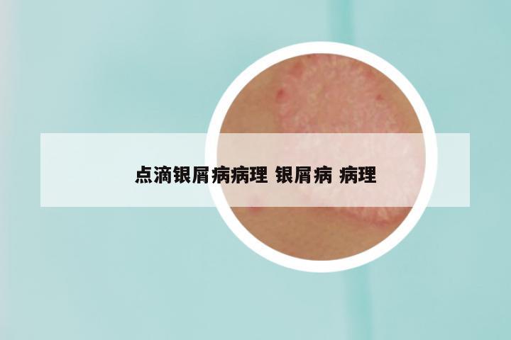 点滴银屑病病理 银屑病 病理