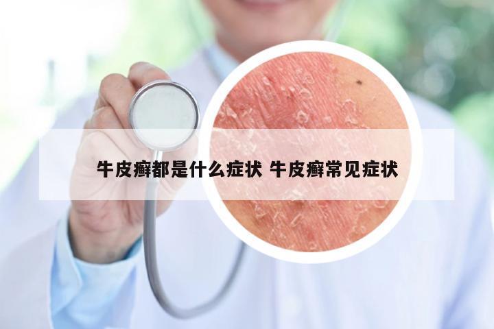 牛皮癣都是什么症状 牛皮癣常见症状