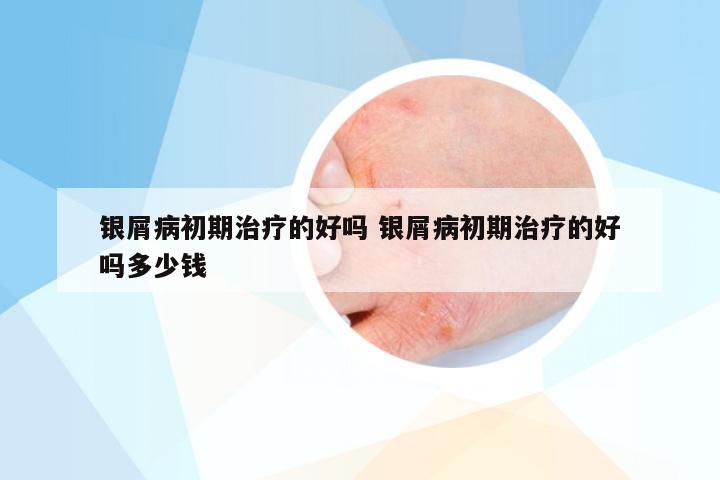 银屑病初期治疗的好吗 银屑病初期治疗的好吗多少钱