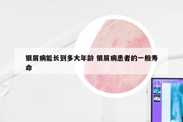银屑病能长到多大年龄 银屑病患者的一般寿命