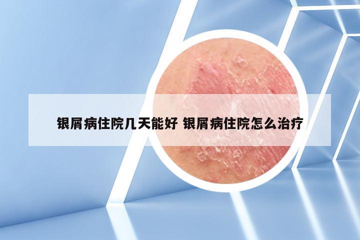 银屑病住院几天能好 银屑病住院怎么治疗