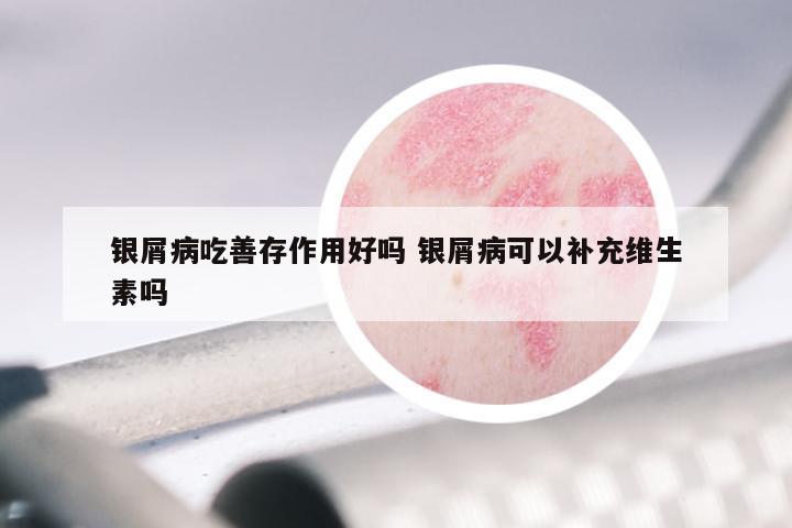 银屑病吃善存作用好吗 银屑病可以补充维生素吗