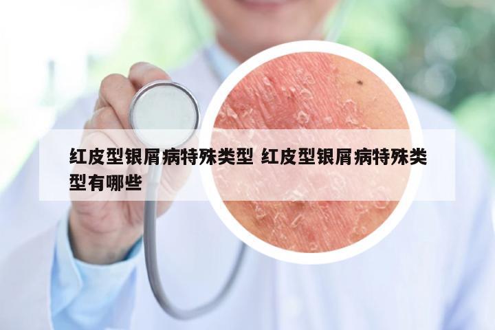 红皮型银屑病特殊类型 红皮型银屑病特殊类型有哪些