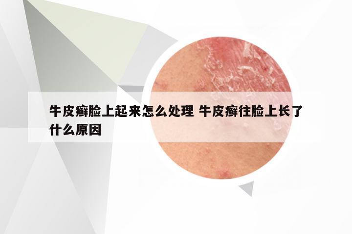 牛皮癣脸上起来怎么处理 牛皮癣往脸上长了什么原因