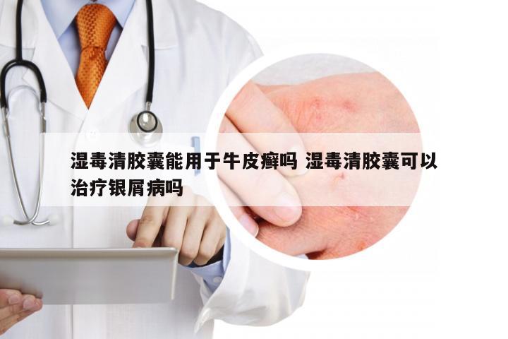湿毒清胶囊能用于牛皮癣吗 湿毒清胶囊可以治疗银屑病吗
