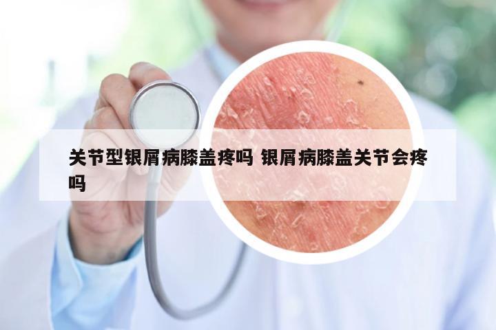 关节型银屑病膝盖疼吗 银屑病膝盖关节会疼吗