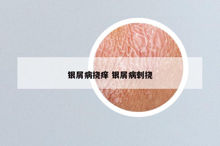 银屑病挠痒 银屑病刺挠