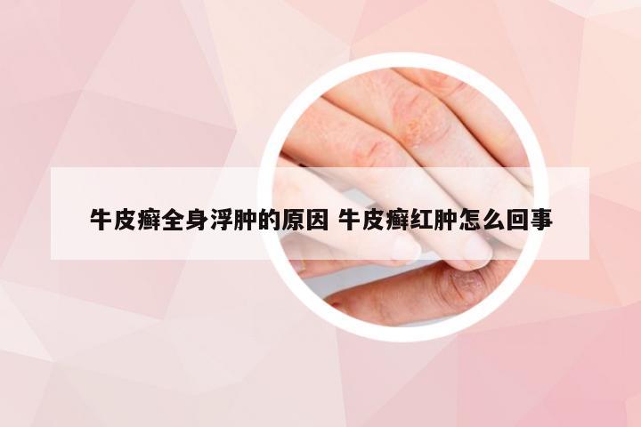 牛皮癣全身浮肿的原因 牛皮癣红肿怎么回事