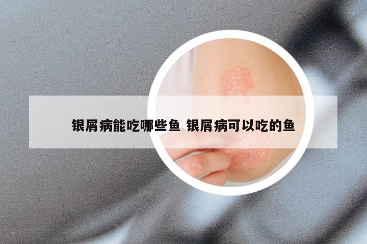 银屑病能吃哪些鱼 银屑病可以吃的鱼