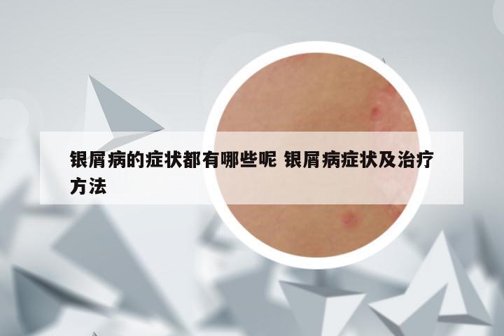 银屑病的症状都有哪些呢 银屑病症状及治疗方法
