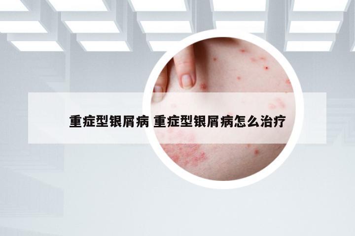 重症型银屑病 重症型银屑病怎么治疗