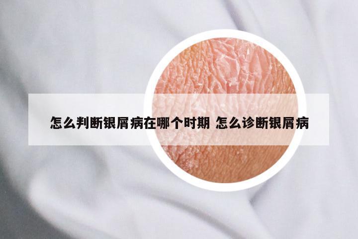 怎么判断银屑病在哪个时期 怎么诊断银屑病