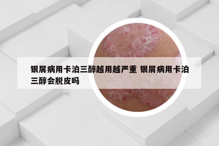 银屑病用卡泊三醇越用越严重 银屑病用卡泊三醇会脱皮吗