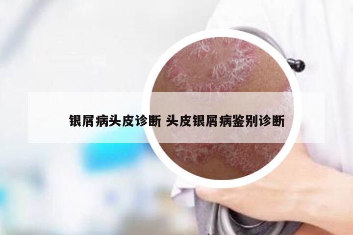 银屑病头皮诊断 头皮银屑病鉴别诊断