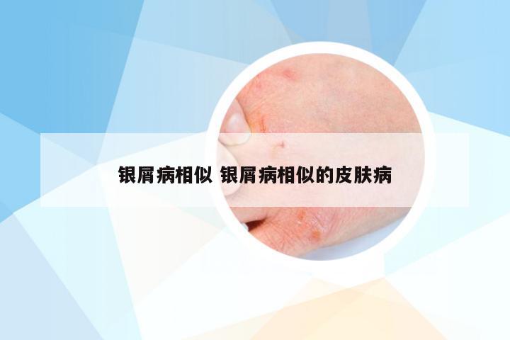 银屑病相似 银屑病相似的皮肤病