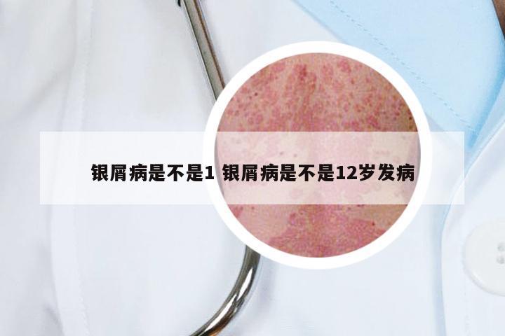 银屑病是不是1 银屑病是不是12岁发病