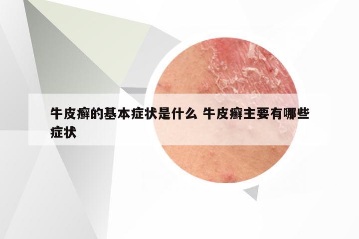牛皮癣的基本症状是什么 牛皮癣主要有哪些症状