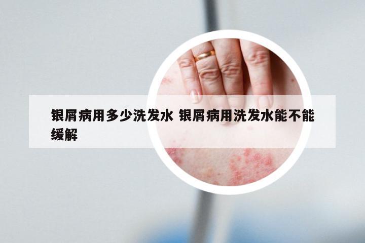 银屑病用多少洗发水 银屑病用洗发水能不能缓解