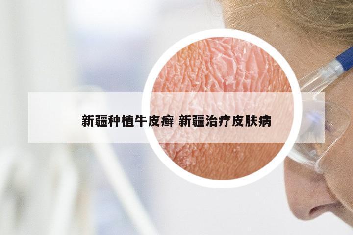 新疆种植牛皮癣 新疆治疗皮肤病