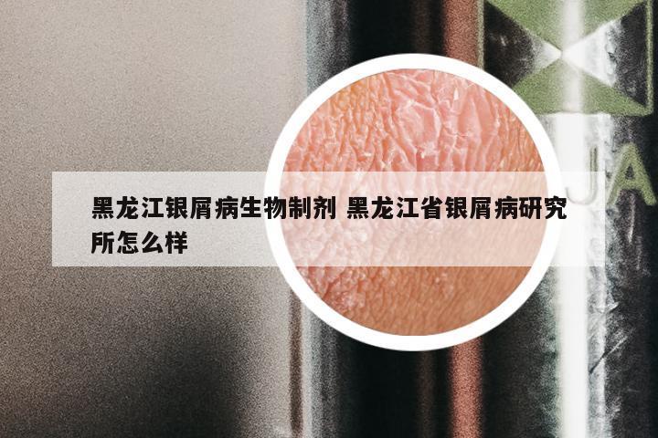 黑龙江银屑病生物制剂 黑龙江省银屑病研究所怎么样
